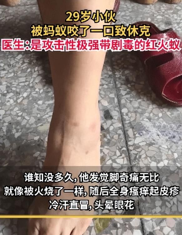 29岁小伙被蚂蚁咬了一口休克入院，医生：这是带剧毒的红火蚁，甚至可导致死亡