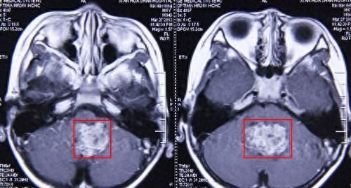 航空总医院神经外科专家谈室管膜肿瘤的病因